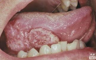 舌背图片,揭秘人体健康密码